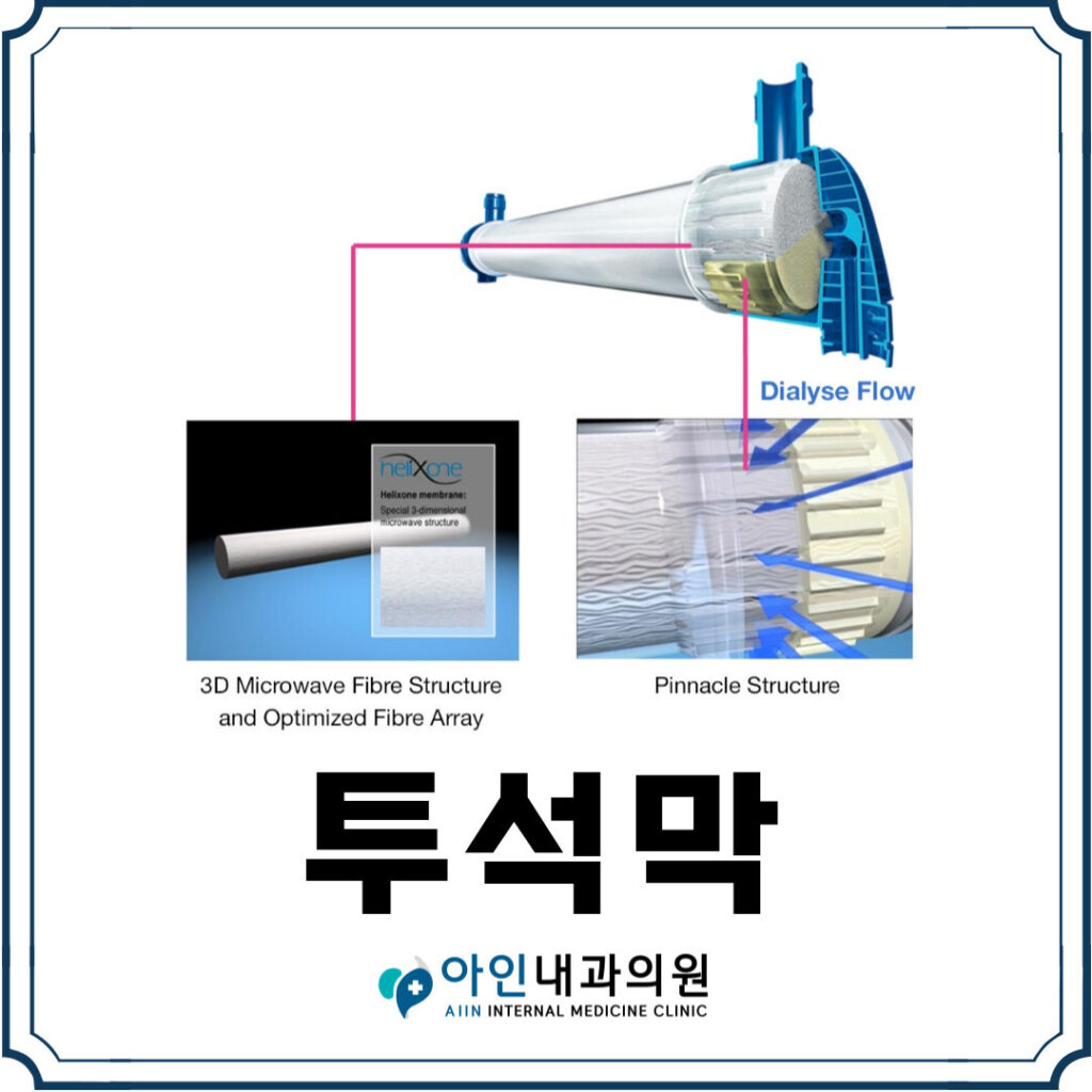 혈액투석 투석막이란? - 아솔내과