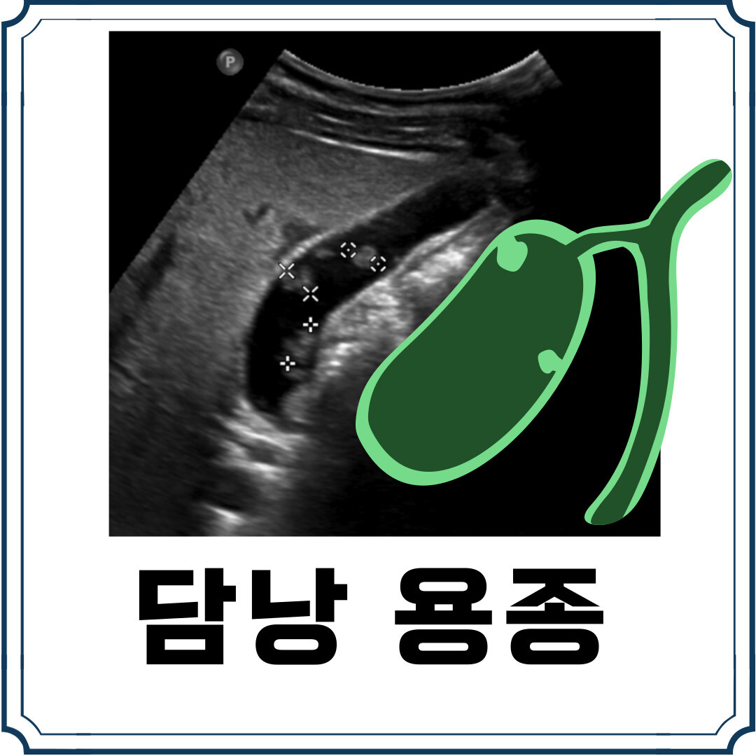 담낭 용종의 진단과 관리 - 아솔내과