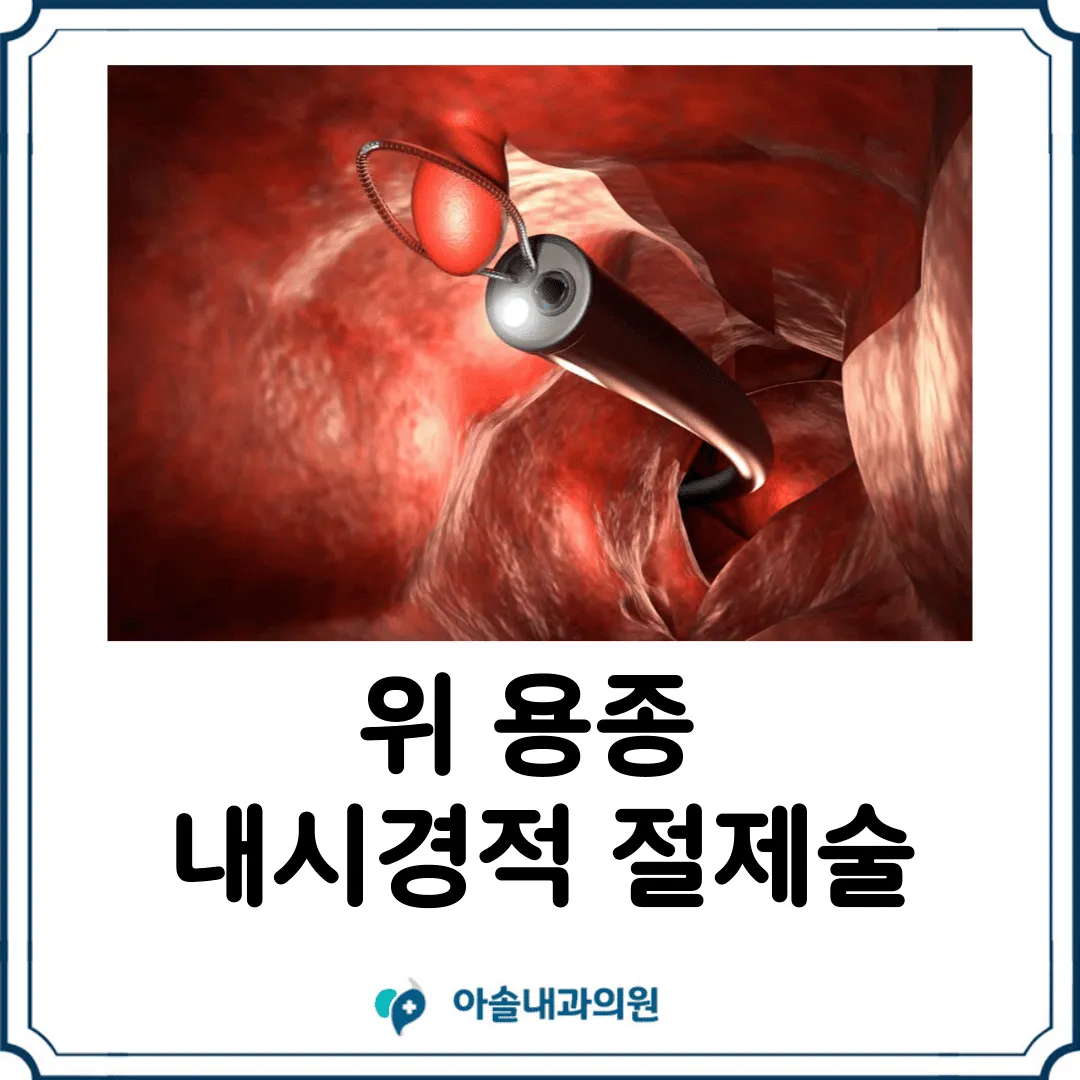 위 용종 내시경적 절제술 | EMR, ESD - 아솔내과