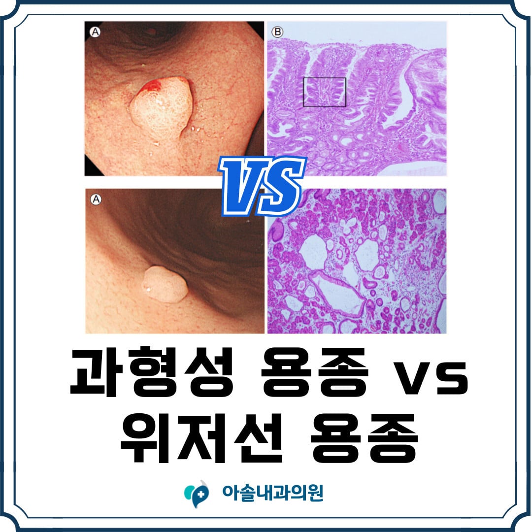 과형성용종과 위저선용종 | 위용종 - 아솔내과