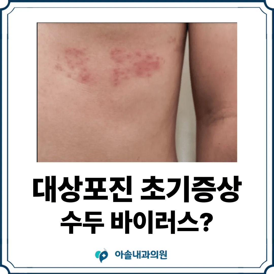검단 대상포진, 대상포진 초기증상: 잠복된 수두 바이러스의 재활성화 - 아솔내과