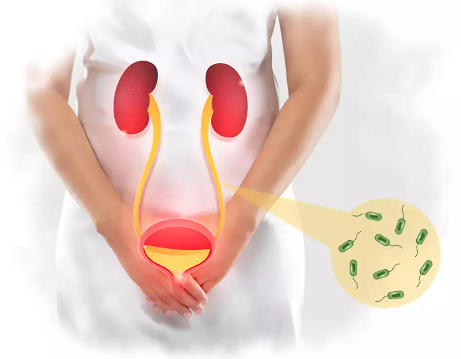 what is cystitis