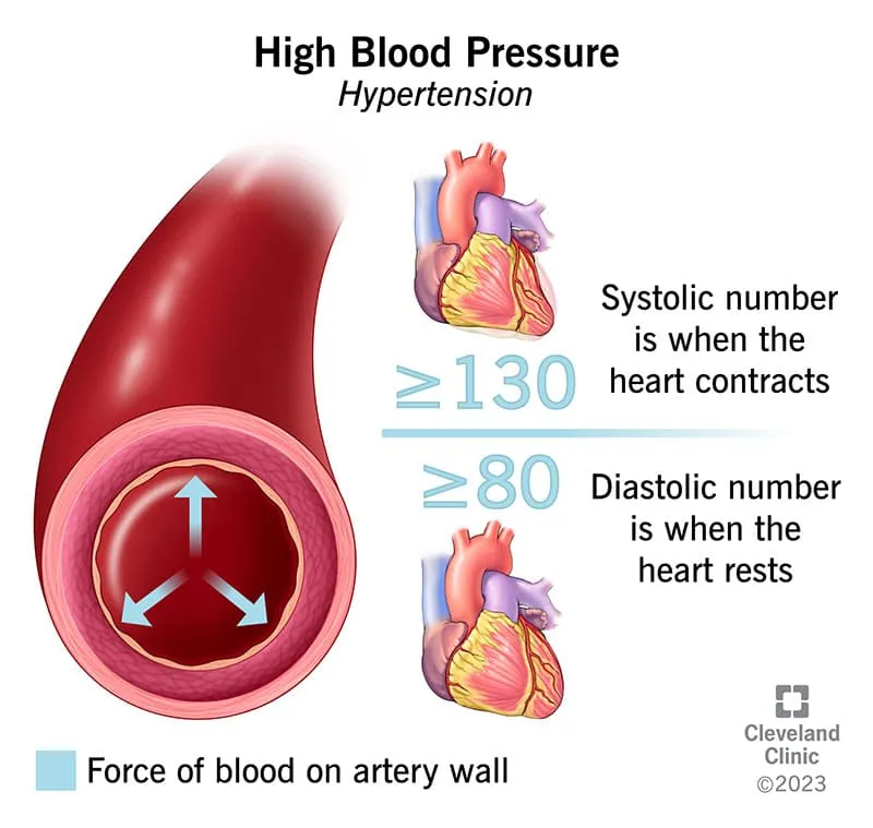 4314 high blood pressure illustration 11zon