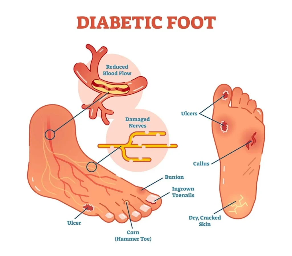Illustration of diabetic foot with ulcers 11zon