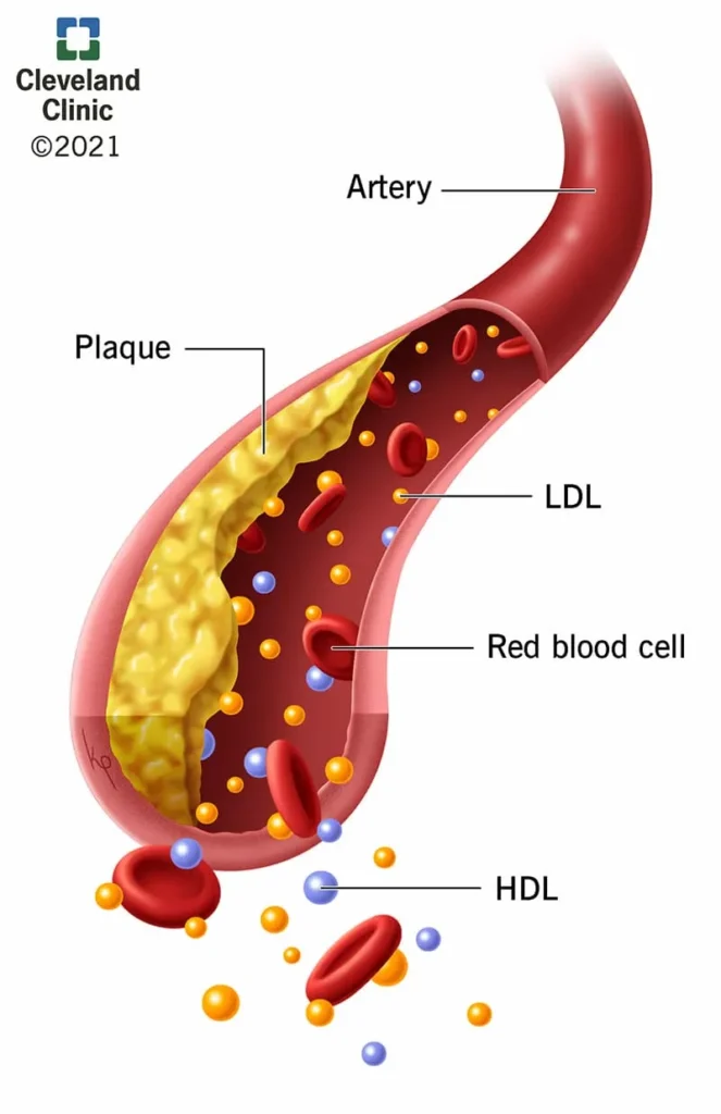 21656 hyperlipidemia illustration 11zon