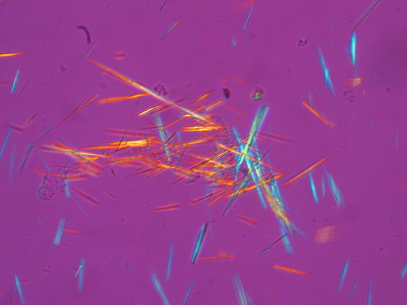 gout crystals