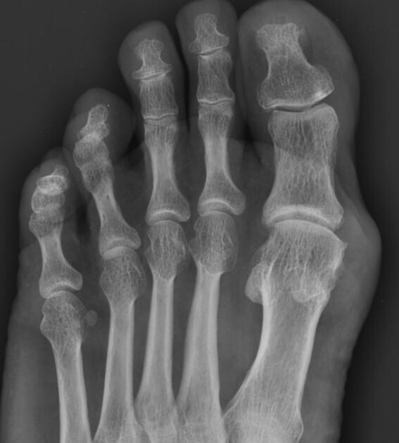 gout