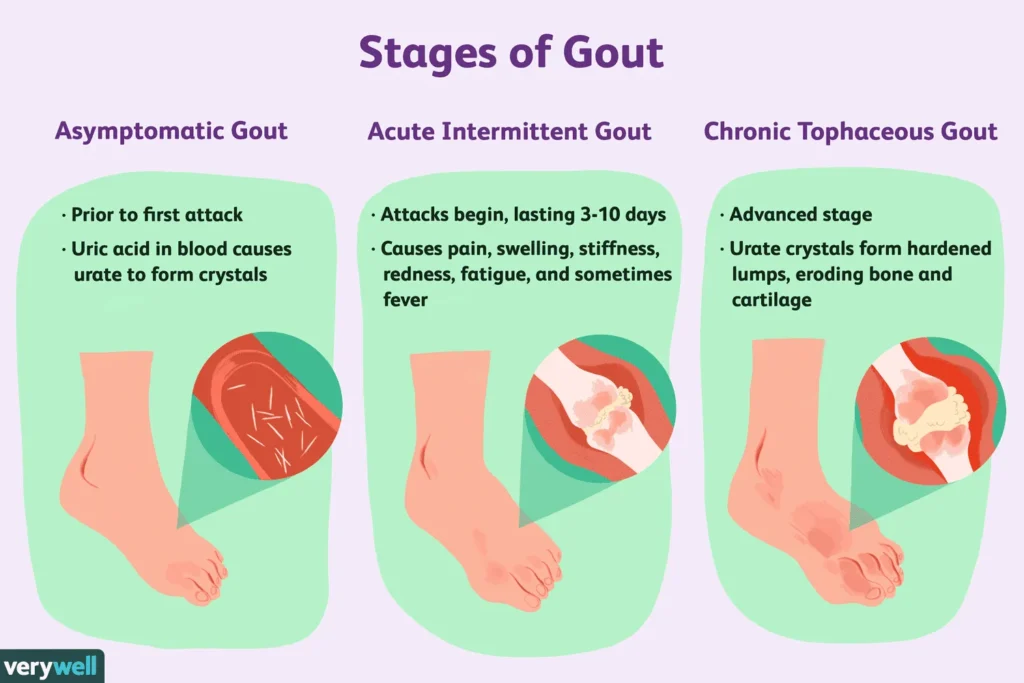 stage of gout 11zon