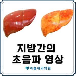 지방간 초음파