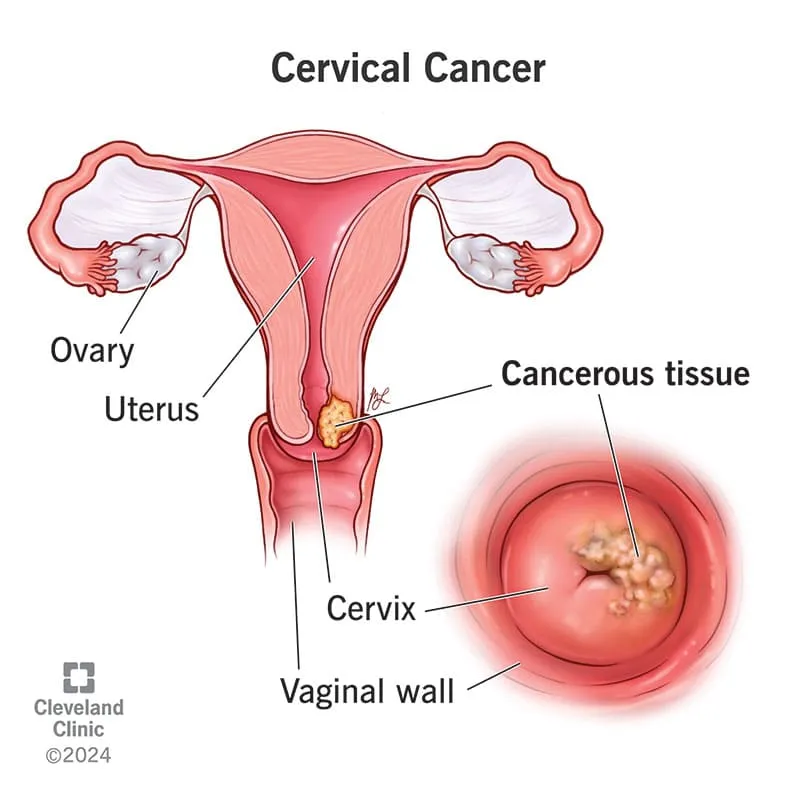 12216 cervical cancer 11zon