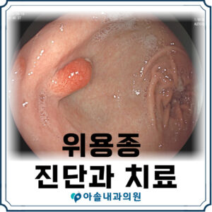 위 용종