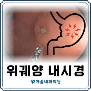 위궤양