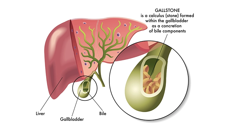659c5dcb69ff411eb4515dd9 Cholelithiasis