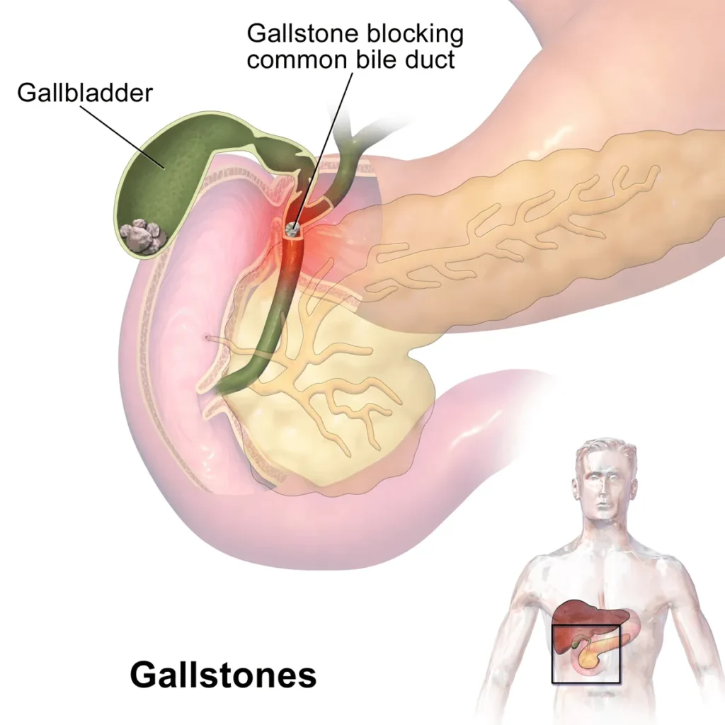 Gallstones 11zon