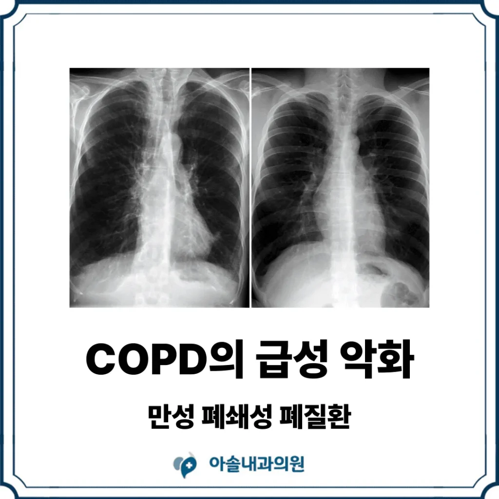 COPD 급성 악화 썸네일