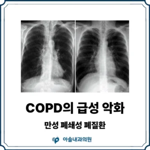 COPD 급성 악화 썸네일