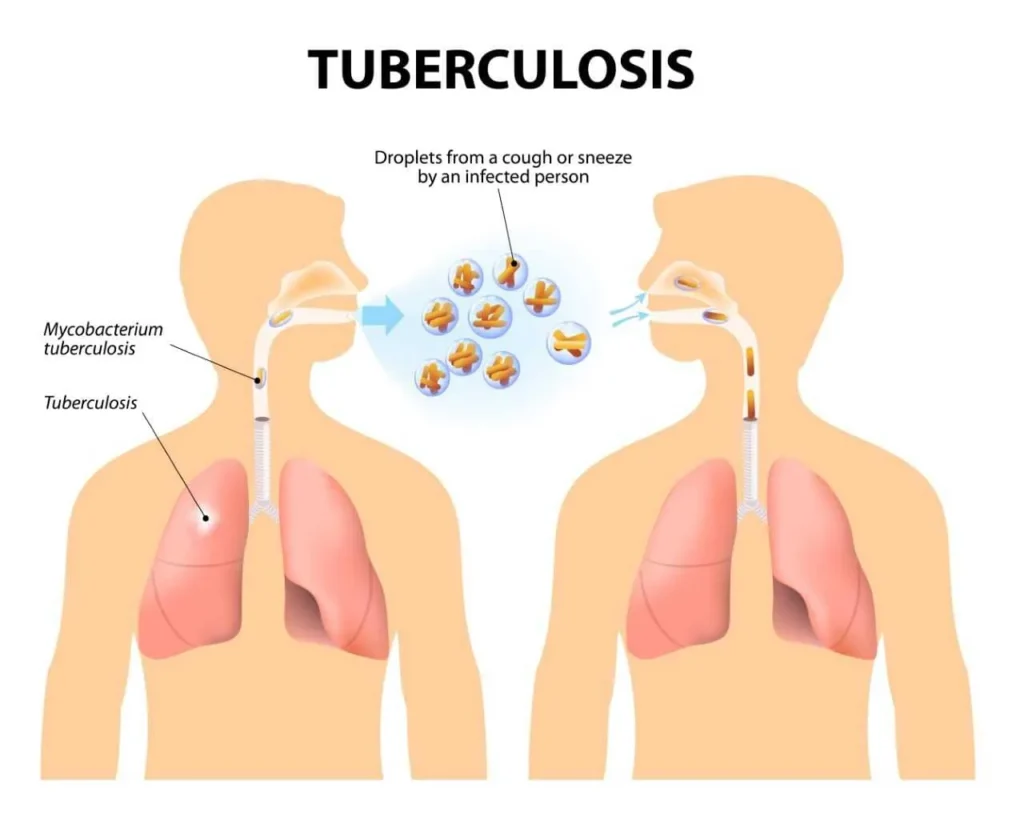 Tuberculosis TB 11zon