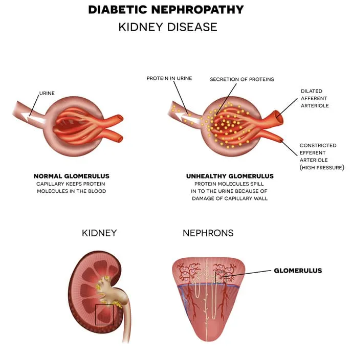 Nephropathy diabetic Nephropathy 11zon