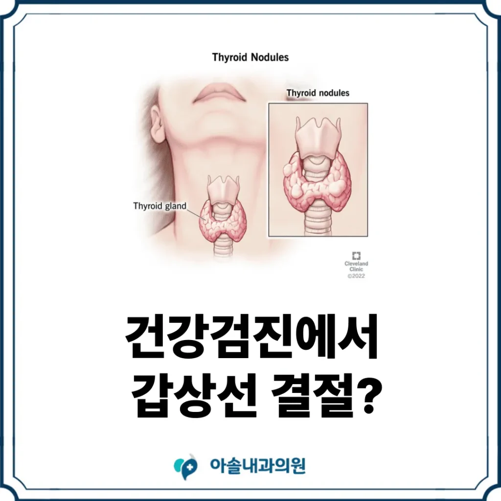 갑상선 결절 썸네일