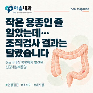 작은 대장용종, 5미리인데 “암”이라고요?